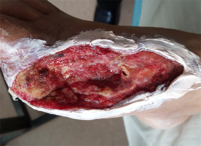 Treatment of Non-Healing Surgical Wound with CDO
