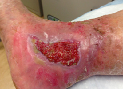 Treatment of a Venous Leg Ulcer using CDO Therapy