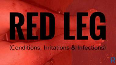 RED LEG (Conditions, Irritations & Infections)