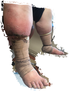 Compression Therapy For Wound Healing